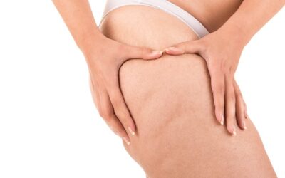 Per il trattamento della cellulite a Milano rivolgetevi allo Studio Dermatologico Bianchi