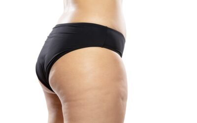 Come trattare smagliature e cellulite con la mesoterapia a Milano