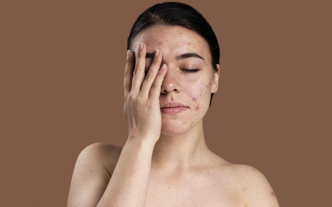 Sconfiggere l’acne: rimedi e cure per liberarsi dai brufoli