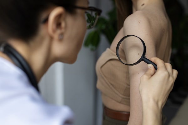 Screening del cancro della pelle: quando, come e perché
